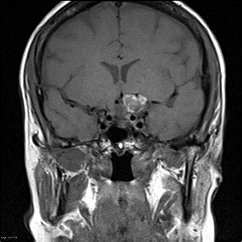 Dermoid Cyst Suprasellar Image