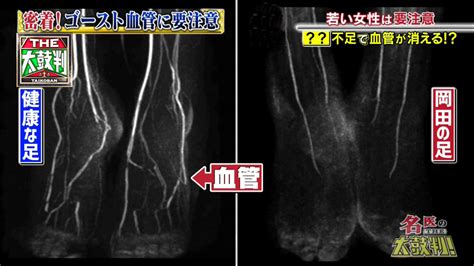 若い女性に増えている「ゴースト血管」って何？知っておきたい改善策とは？｜名医のthe太鼓判！｜tverプラス テレビ番組最新情報＆エンタメ