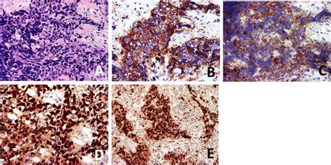 Hematoxylin Eosin Staining A And Immunohistochemical Staining For