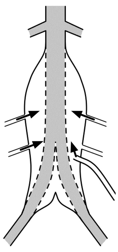 Endoleaks After Endovascular Abdominal Aortic Aneurysm Repair