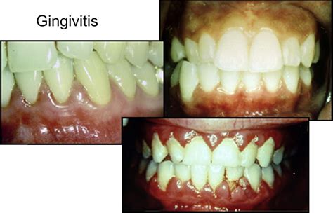 Oral Health And Dental Care During Pregnancy Dental Clinics