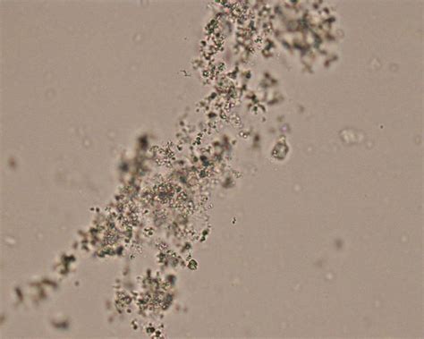 Tyrosine Crystals In Urine