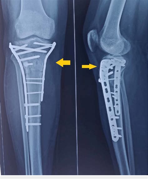 Tibial Tuberosity Osteotomy