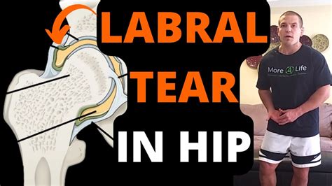 Labral Tear In Hip Symptoms Treatment Exercises For Labral Tear