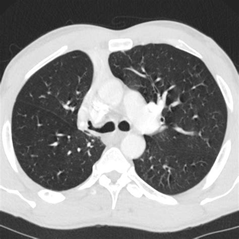 186lu Right Upper Lobe Collapse Lungs