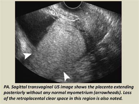 Presentation1 Radiological Imaging Of Placenta Accreta