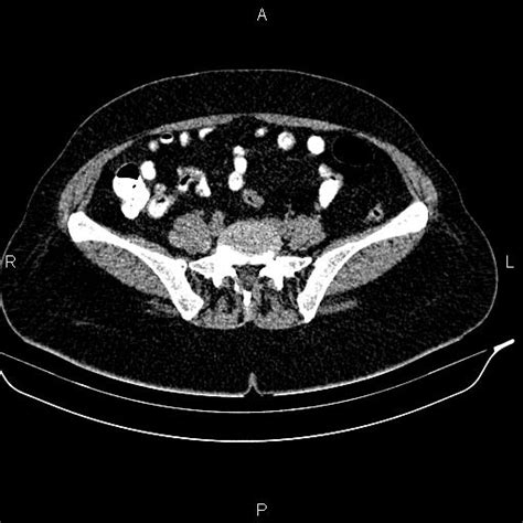 Appendiceal Mucocele Image