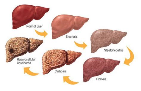 How Liver Cancer Develops in Human Body - YourLiverLife