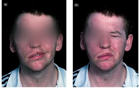 Facial Nerve Paralysis 15 مدونة الدكتور حمدى زكريا الطبية