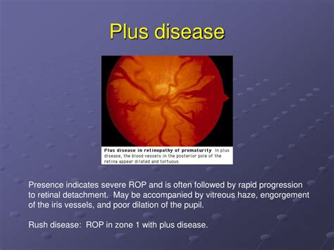 Retinopathy Of Prematurity Plus Disease