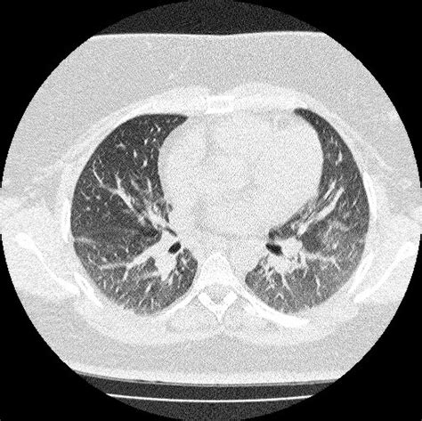 Southwest Journal Of Pulmonary Critical Care And Sleep Imaging Medical Image Of The Week