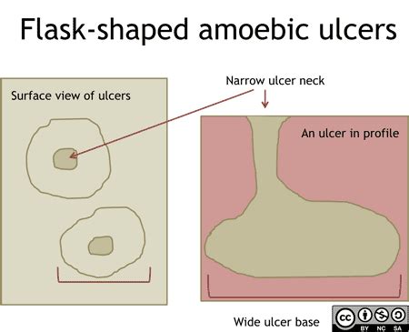 Amoebiasis Pathology Learning Centre