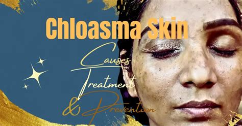 Chloasma Skin: Causes, Treatment & Prevention For Healthy Skin