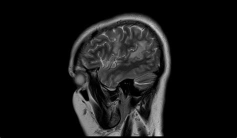 Neurocysticercosis Mri Radiology Article On Neurocysticercosis