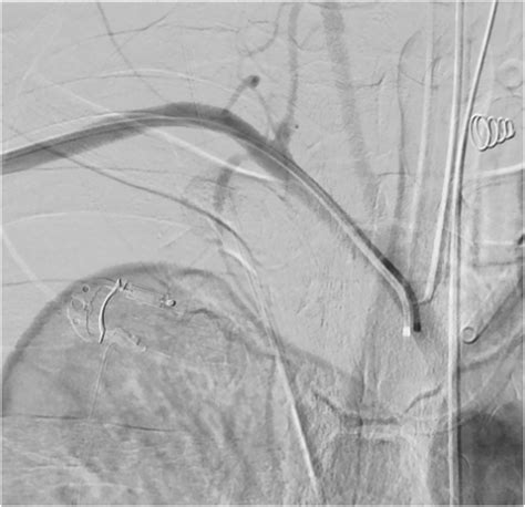 Tctap C A Challenging Case Report Hemostasis Of Right Subclavian