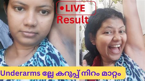 Underarms Darkness Removal Live Result Malayalamഒറ്റ യൂസിൽ തന്നെ