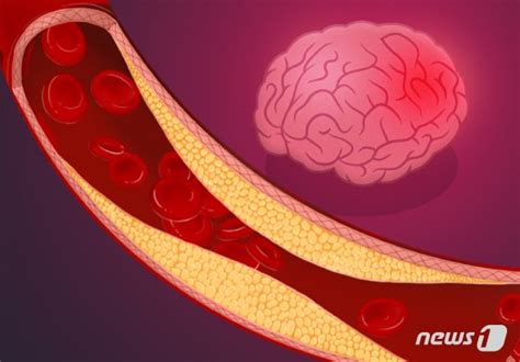 동맥경화 지수 높으면 치매 부르는 뇌소혈관질환 위험↑ 네이트 뉴스