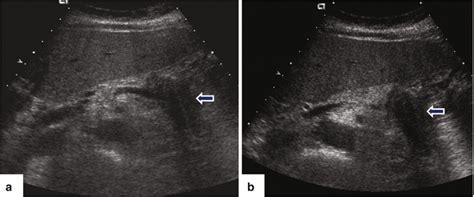 Pancreatic Ductal Adenocarcinoma Pdac Radiology Key