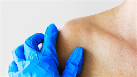 Comprehensive Guide To Clavicle Fracture Orif Orif Clavicle