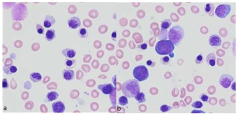 Diagnostics Free Full Text When Ring Sideroblasts On Bone Marrow Smears Are Inconsistent