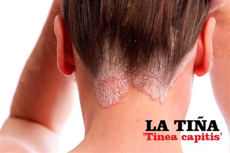 La TiÑa Tinea