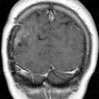 T Weighted Gadolinium Enhanced Brain Magnetic Resonance Imaging