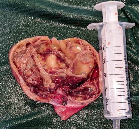 Cut Surface Of Encysted Hydrocoele Showing Its Multilocular Structure