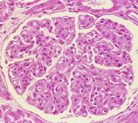 Renal Fellow Network Classification Of Cryoglobulins And Mpgn