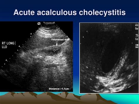 Ppt Pathology Of The Gall Bladder And Biliary Tree Powerpoint Presentation Id 3585337