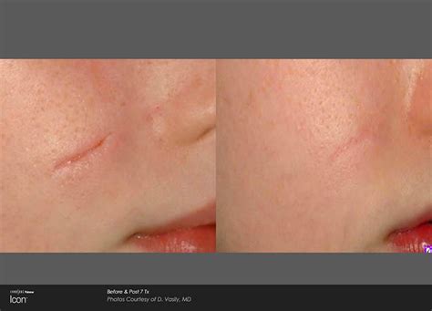 Everything You Need To Know About Icon Laser By Cynosure Derm Collective