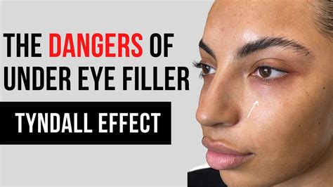 Botched Under Eye Filler Gone Wrong Tear Trough Tyndall Effect Youtube