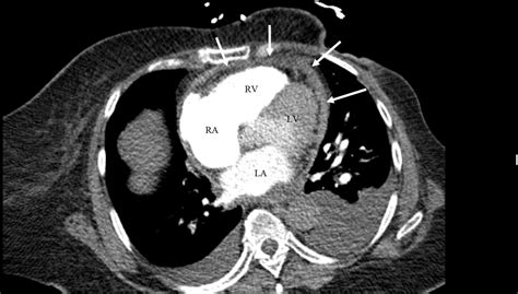 Effusiveconstrictive Pericarditis In The Spectrum Of Pericardial