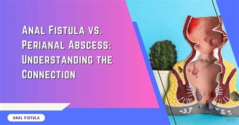 Anal Fistula Vs Perianal Abscess Key Insights Explained