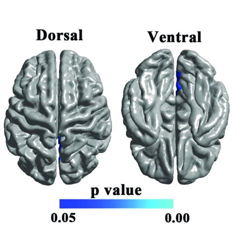 Correlation Of Local Gyrification Index LGI With Cognitive Clinical