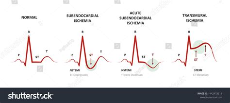 Diagnosis Myocardial Ischemia Nstemi Stemi Ekg Ilustrație de stoc 1442473619