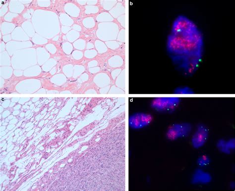 Well Differentiated Liposarcoma Atypical Lipomatous Tumor Adipocytes