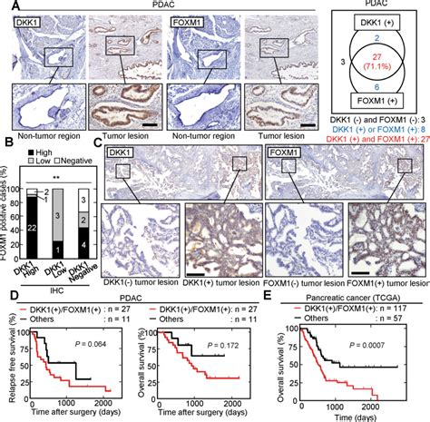 The Dickkopf1 And FOXM1 Positive Feedback Loop Promotes Tumor Growth In