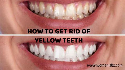 How To Get Rid Of Yellow Teeth Womanishs