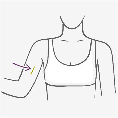 Contraceptive Implant - Hormonal Method