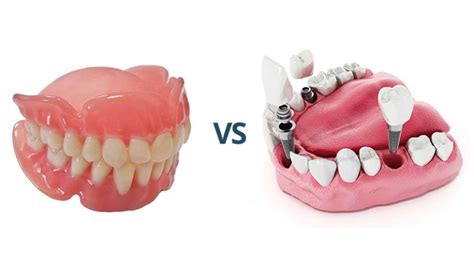 Dentures Vs Dental Implants A Comprehensive Comparison DICC