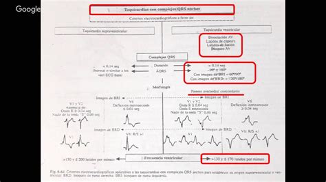 Taquicardia Ventricular Youtube