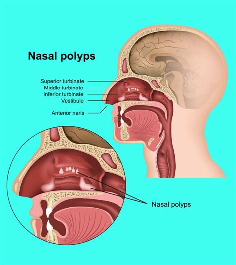 Nasal Polyps Medical Vector Illustration White Background Eps Stock