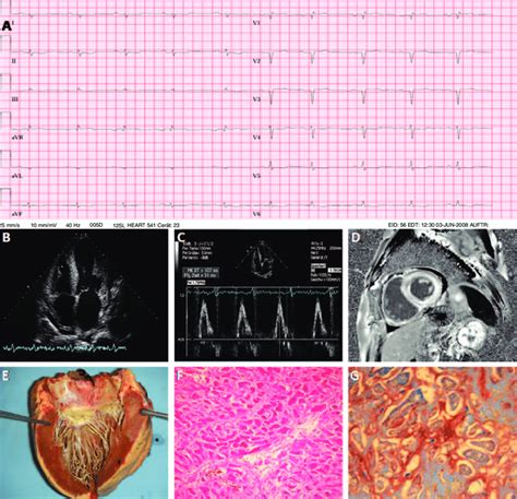 Clinical And Morphological Fi Ndings In Cardiac Amyloidosis A Ecg