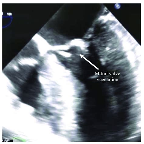 Echocardiography Showing The Mitral Valve With A Vegetation Attached To Download Scientific