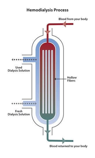 Hemodialysis - NIDDK