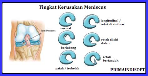 Cedera Yang Biasa Menimpa Para Atlet Blog Primaindisoft