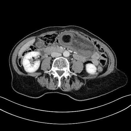 Intussusception Due To Small Bowel Lipoma Radiology Case