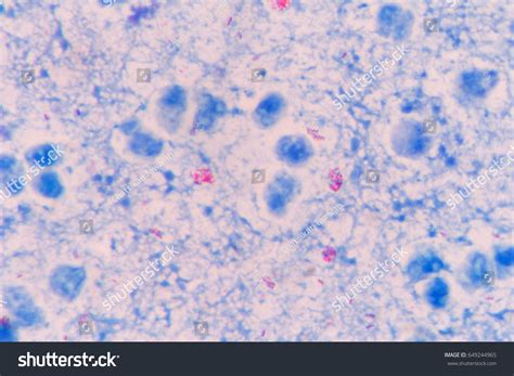 Mycobacterium Tuberculosis Acid Fast Stain