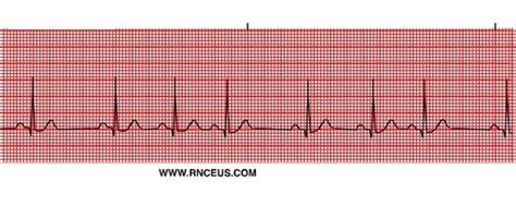 Ekg Pictures Flashcards Quizlet