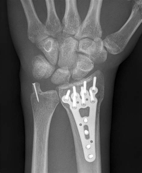 Dorsal Palmar X Ray Of The Wrist 5 Weeks After Surgery Refixation Of